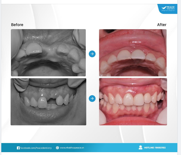 MẤT RĂNG NHIỀU NĂM, TIÊU XƯƠNG, TEO/TỤT NƯỚU & KẾ HOẠCH ĐIỀU TRỊ TỐI ƯU