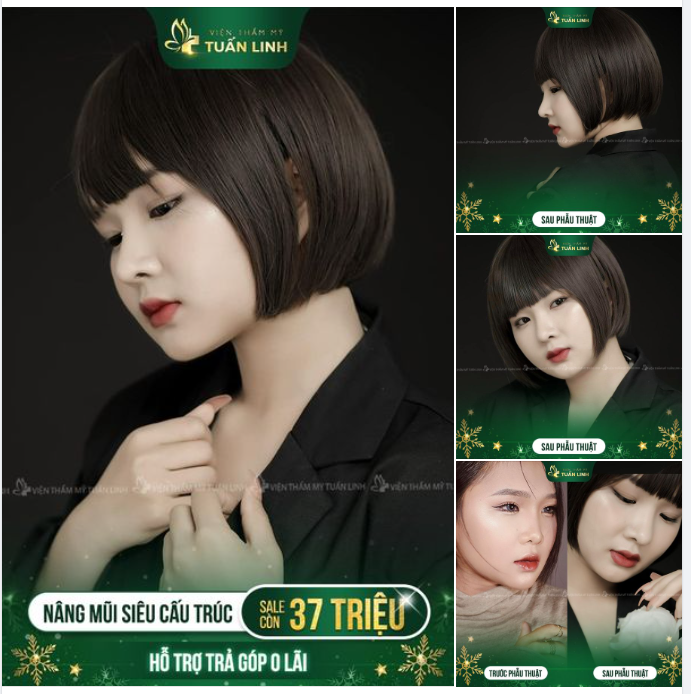 Nâng mũi siêu cấu trúc Sale còn: 37Triệu ( giá gốc 65 triệu).