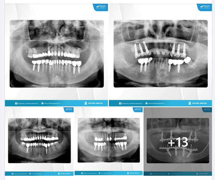 TRỒNG RĂNG IMPLANT CÓ THỂ SỬ DỤNG TRỌN ĐỜI?