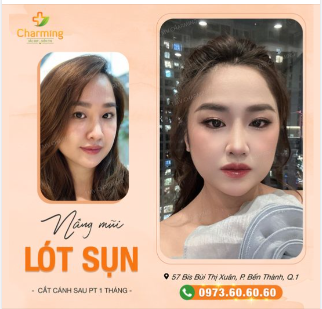Để có được chiếc mũi đẹp là cả một QUÁ TRÌNH