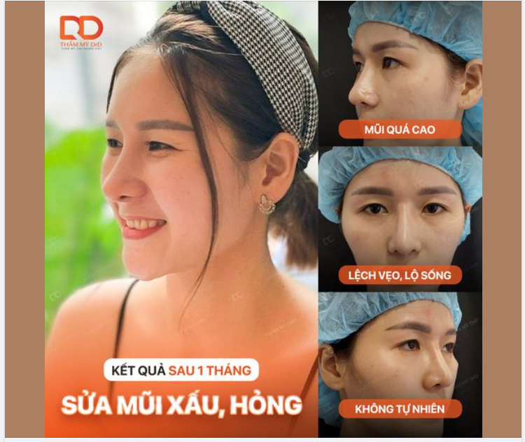"Giải cứu" ca mũi xấu và kết quả sau 1 tháng.