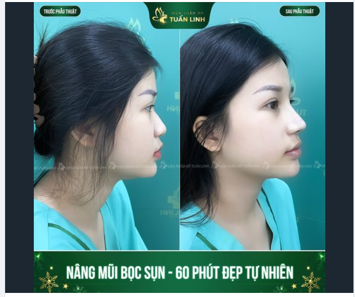 Chỉ với 15Triệu và 60 phút '' nằm ngủ" bạn sẽ có được dáng mũi cao đẹp tự nhiên như thế này!!