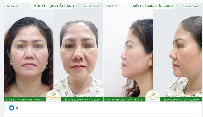 Bạn có tin là nâng mũi cũng có thể giúp gương mặt "bớt lệch" không? Cô khách của Charming là một ví dụ đây