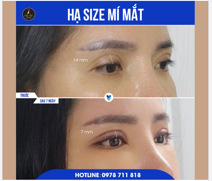 NÂNG TẦM ĐÔI MẮT ĐẸP Không khó khi có Dr Trí lo!