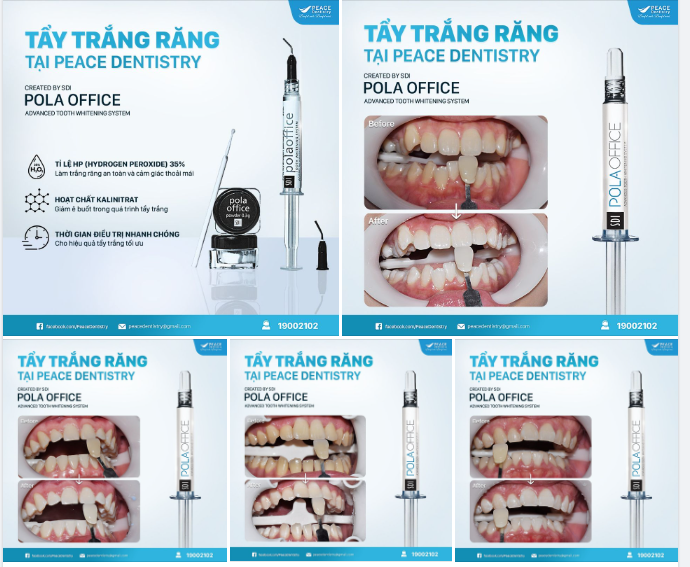 BẠN ĐANG LO LẮNG VỀ TÌNH TRẠNG Ê BUỐT RĂNG KHI TẨY TRẮNG TẠI NHA KHOA?