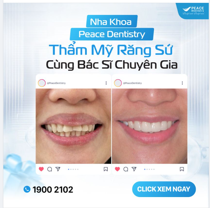 RĂNG TOÀN SỨ CAO CẤP ƯU ĐÃI ĐẾN 40% - ĐỪNG BỎ LỠ CƠ HỘI SỞ HỮU NỤ CƯỜI HOÀN HẢO