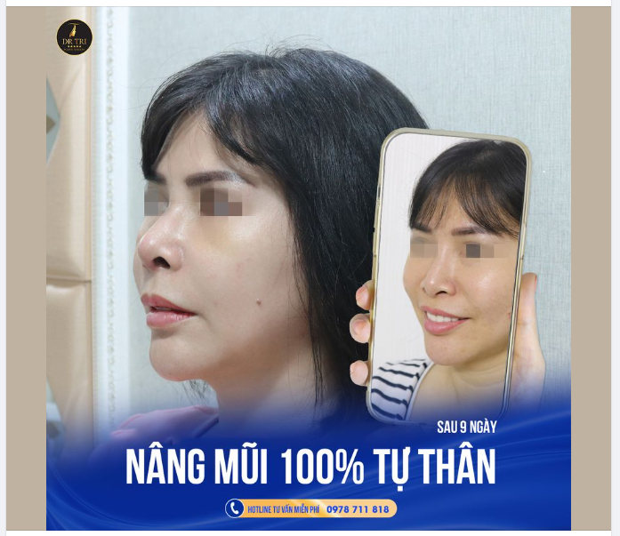 Bất Ngờ!!! Nhờ vào phương pháp Nâng mũi 100% tự thân từ Dr Trí