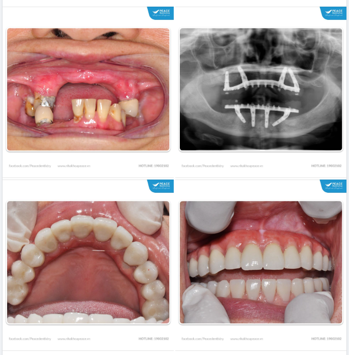 Ca lâm sàng Implant toàn hàm cho cô khách hàng lớn tuổi mất gần hết răng và đây thành quả sau 10 ngày