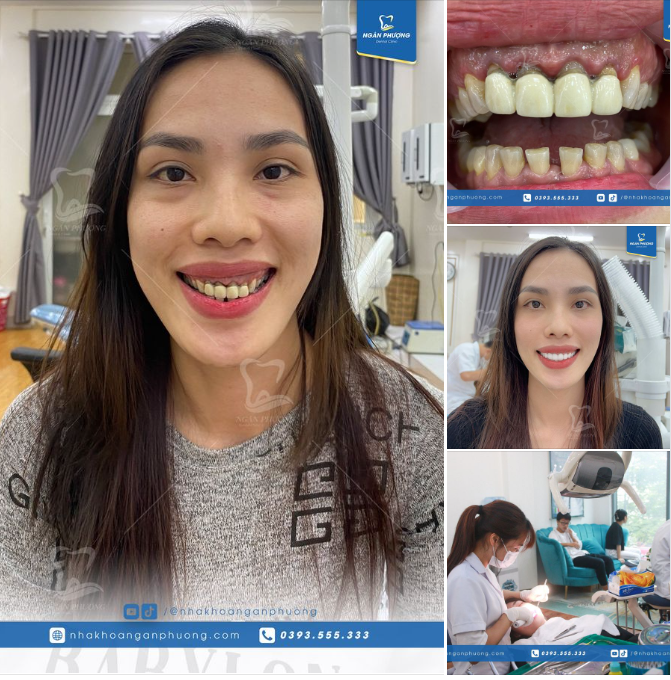 Lựa chọn sứ toàn phần, tránh bị đen cùi răng, viêm lợi khi sử dụng lâu năm