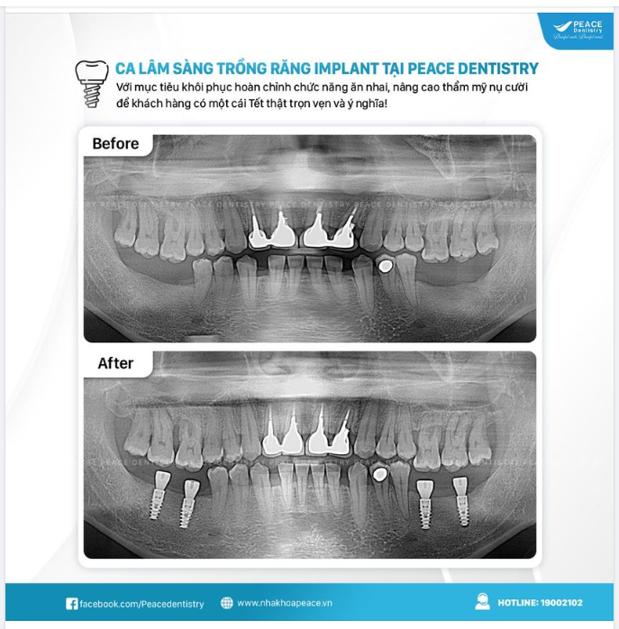ĐÓN NĂM MỚI, TRỒNG RĂNG MỚI CÙNG ƯU ĐÃI HẤP DẪN
