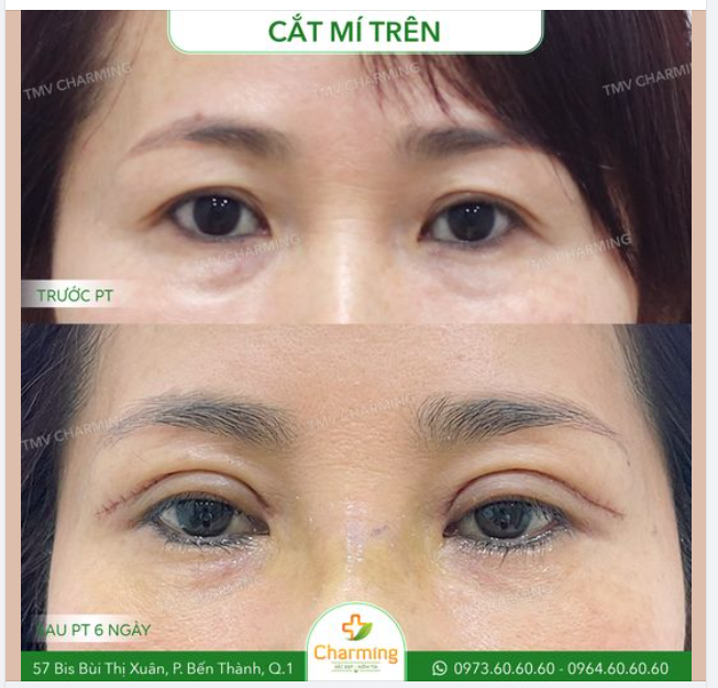 Bạn tự ti vì hai mí mắt không rõ ràng khiến nhiều người nhìn thành mí lót ư? Bạn không cần phải lo vì giờ đây đã có phương pháp cắt mí trên có thể giúp bạn hô biến đôi mắt ấy thành đôi mắt hai mí to tròn, thu hút.