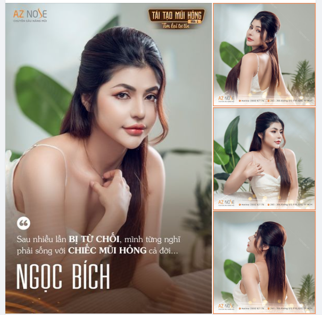 Tìm lại tự tin sau 5 tháng tái tạo dáng mũi bởi BS CKI. Nguyễn Hoàng Nam