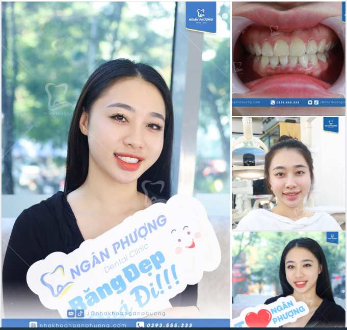 Tụt lợi, men răng yếu, màu ố vàng đều có thể khắc phục một lần bằng cách làm răng sứ