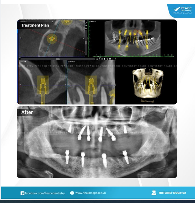 Ca lâm sàng  Implant toàn hàm dày công & đòi hỏi bác sĩ phẫu thuật phải có thể lực tốt cũng như khả năng tập trung cao độ trong một thời gian dài.