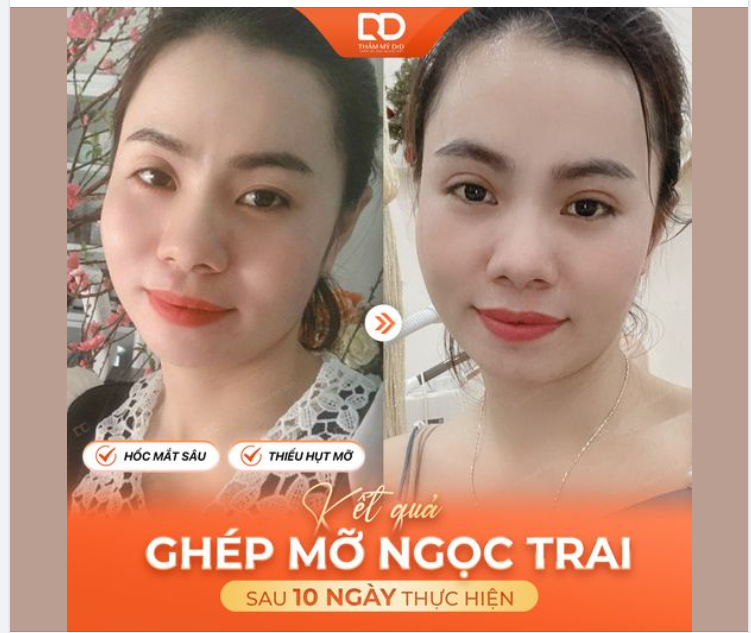 GƯƠNG MẶT TRẺ HƠN SAU GHÉP MỠ NGỌC TRAI