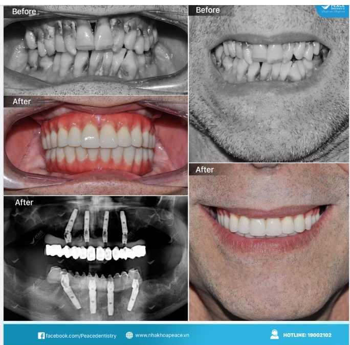 Ca lâm sàng All-on-4 Implant cho khách hàng đến từ Mỹ