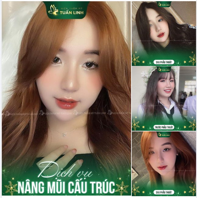 Những bạn có gương mặt hơi bầu bĩnh, thích dáng mũi tự nhiên thì tham khảo ngay dáng mũi này nhà Tuấn Linh nha.