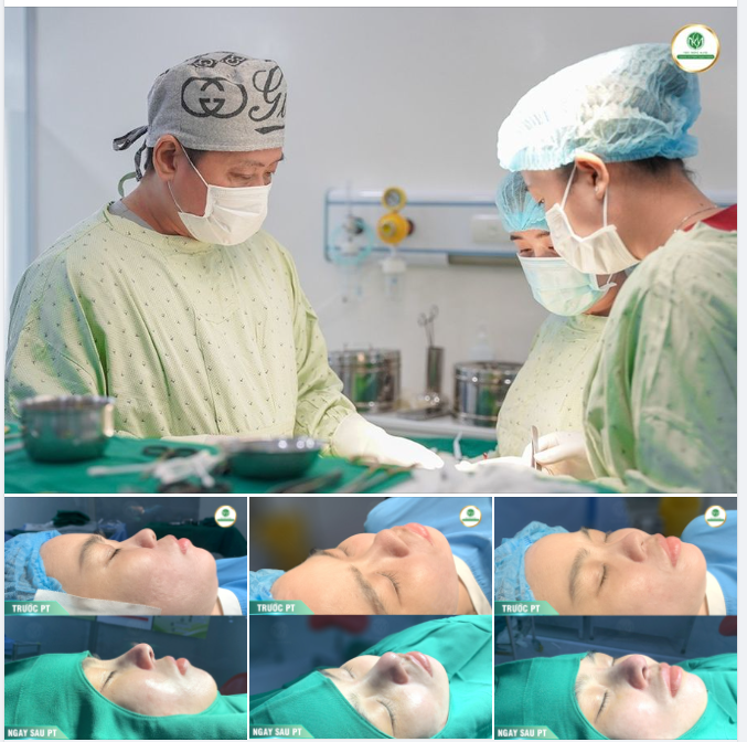 NÂNG MŨI S LINE - ĐẸP SANG ĐÚNG CHUẨN