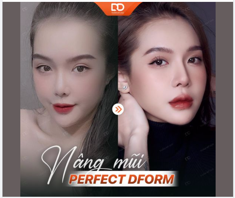 TỰ TIN HƠN, THẦN THÁI HƠN VỚI NÂNG MŨI PERFECT DFORM