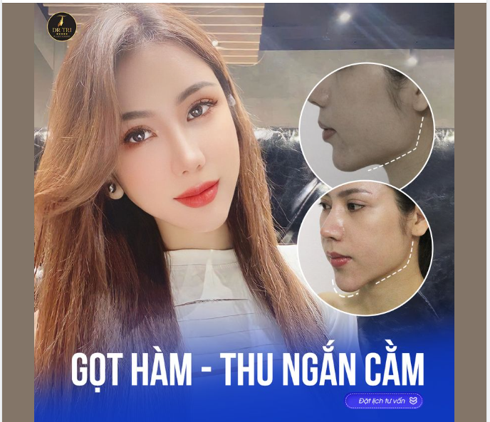 Khách hóa “thần tiên tỷ tỷ” sau khi Gọt hàm - thu gọn cằm tại Dr Trí