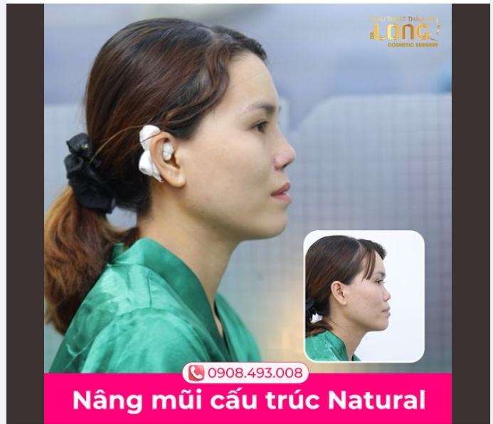 TẶNG BẠN MŨI XINH RINH NHIỀU CƠ HỘI NÂNG MŨI THÁNG 12 GIẢ.M ĐẬM SÂU