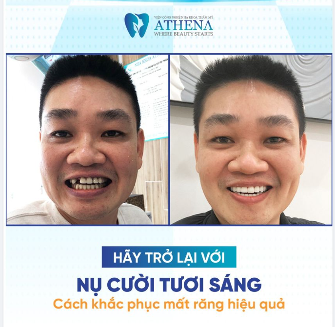 KHÔI PHỤC NỤ CƯỜI TƯƠI SÁNG - KHẮC PHỤC MẤT RĂNG HIỆU QUẢ
