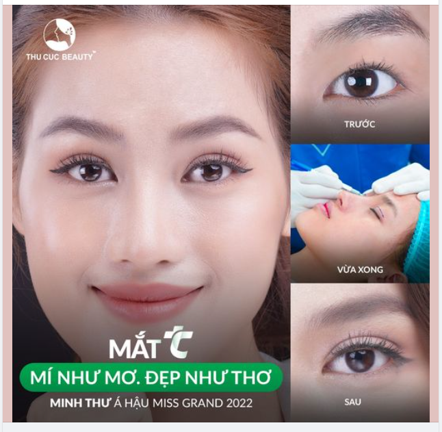 Xóa sổ tình trạng một mí, mí lót Chọn Mắt TC