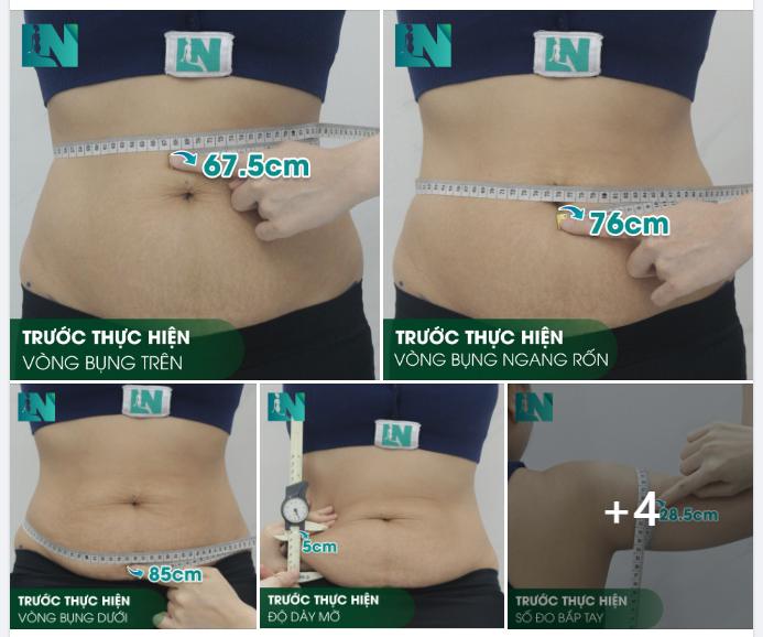 HÌNH ẢNH TRƯỚC KHI THỰC HIỆN HÚT MỠ TẠO DÁNG BỤNG - EO - HÔNG VÀ TAY - LƯNG - NÁCH CHO CHỊ KHÁCH SINH NĂM 1990