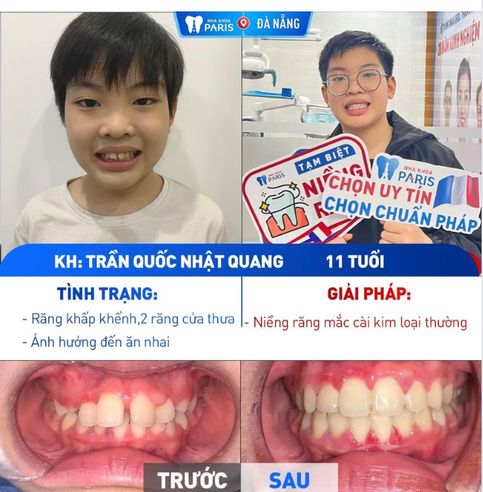 BIẾN ĐỔI HÀM RĂNG KHẤP KHỂNH