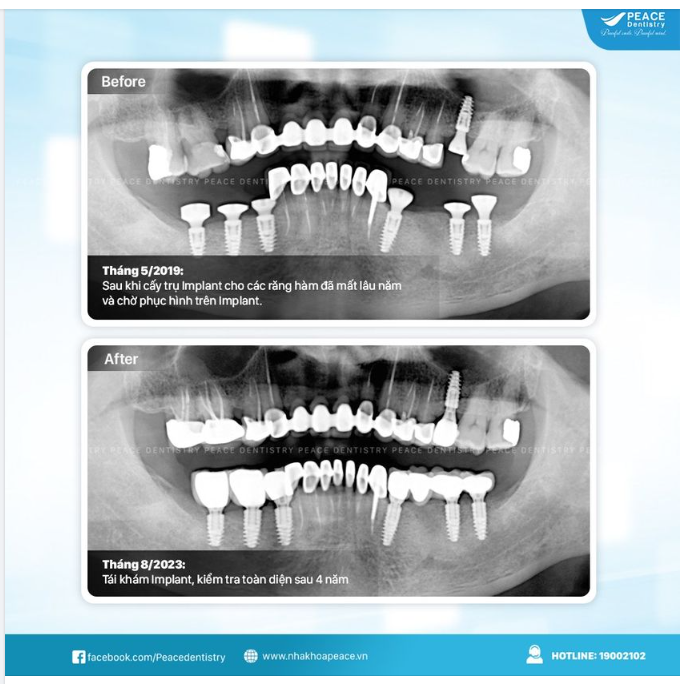 Dưới đây là các đánh giá ghi nhận của bác sĩ Peace Dentistry với khách hàng tại thời điểm tái khám sau 4 năm: