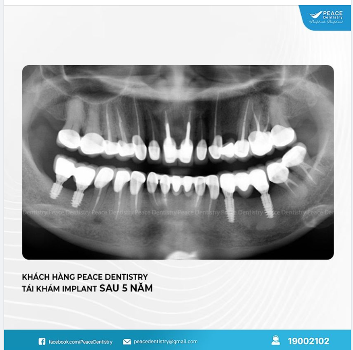 TÁI KHÁM ĐỊNH KỲ - BÍ QUYẾT NÂNG CAO TUỔI THỌ RĂNG IMPLANT LÂU DÀI
