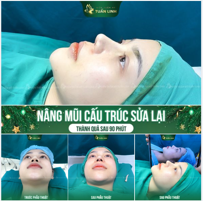 Dáng mũi cao sang, tự nhiên đẹp từ mọi góc nhìn của khách nhà Tuấn Linh chỉ sau 90 phút thực hiện.