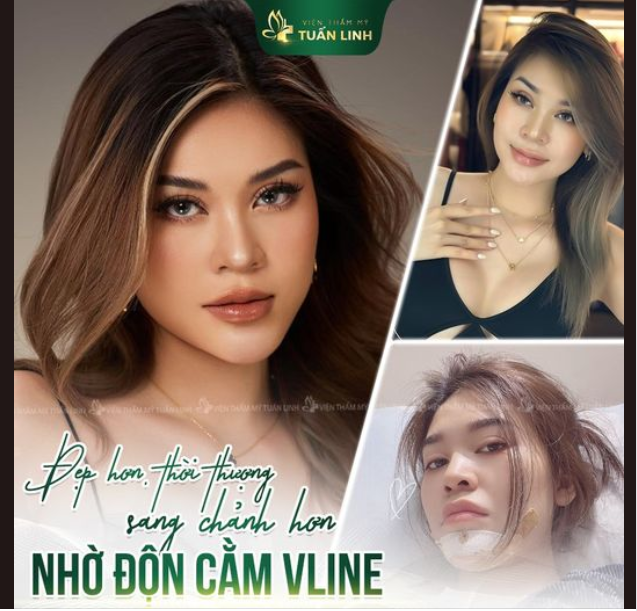 ĐỘN CẰM V-LINE cho khuôn mặt đẹp sang chảnh, thời thượng.
