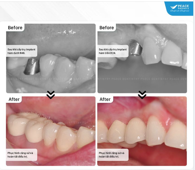 Hỏi đáp nha khoa  Trồng răng Implant: "Chào bác sĩ, cắm trụ Implant sau bao lâu mới có thể cố định răng sứ hoàn chỉnh?"
