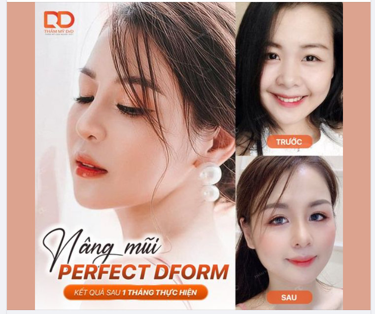 CHỈ SAU 1 THÁNG, MŨI ĐẸP ÔM FORM