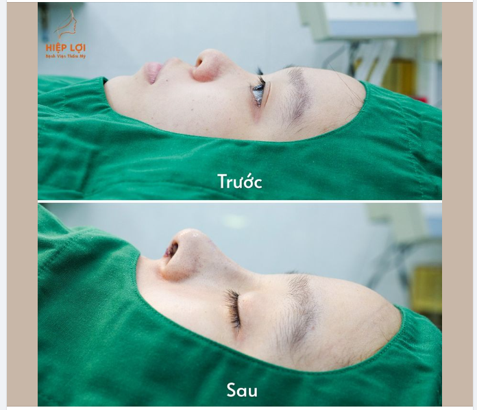Nâng Mũi Cấu Trúc Sụn Sườn Tự Thân