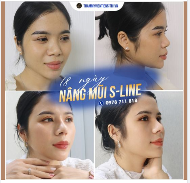 Nâng Mũi S-line - Đường Cong Tiêu Chuẩn