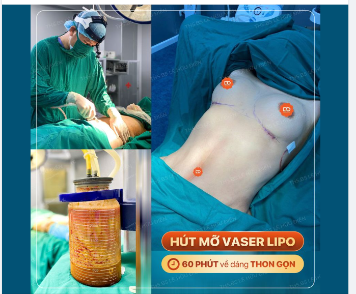 HÚT MỠ VASERLIPO – 60 PHÚT CÓ DÁNG “NGON”