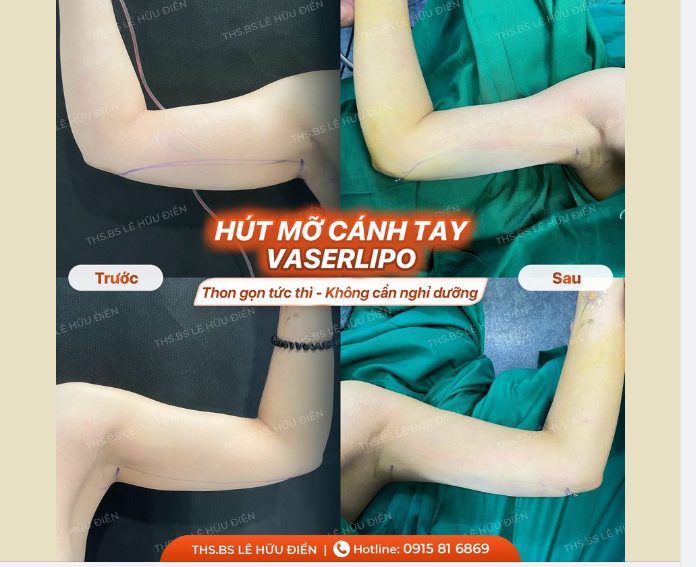 SAO PHẢI LO BẮP TAY TO?