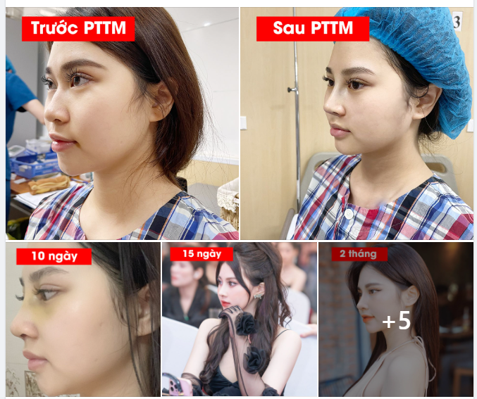 Hành trình nâng mũi của nàng “HOT GIRL” đến từ Nam Định