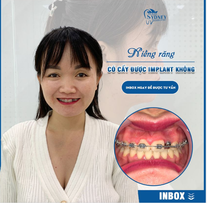 NIỀNG RĂNG CÓ CẤY IMPLANT ĐƯỢC KHÔNG?