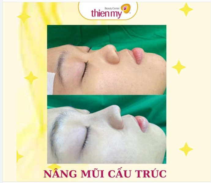 Nâng mũi cấu trúc - Phương pháp cải thiện mũi có khá nhiều khuyết điểm, mong muốn có dáng mũi hoàn hảo nhất có thể.