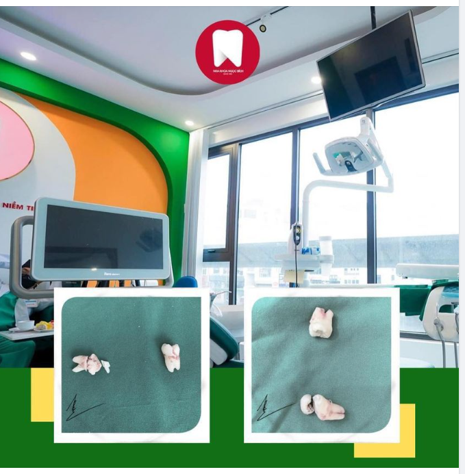 NHỔ RĂNG KHÔN CẦN BÁC SĨ CÓ TAY NGHỀ CAO