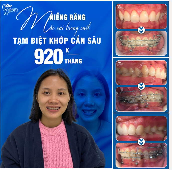 TẠM BIỆT KHỚP CẮN SÂU BẰNG PHƯƠNG PHÁP NIỀNG RĂNG