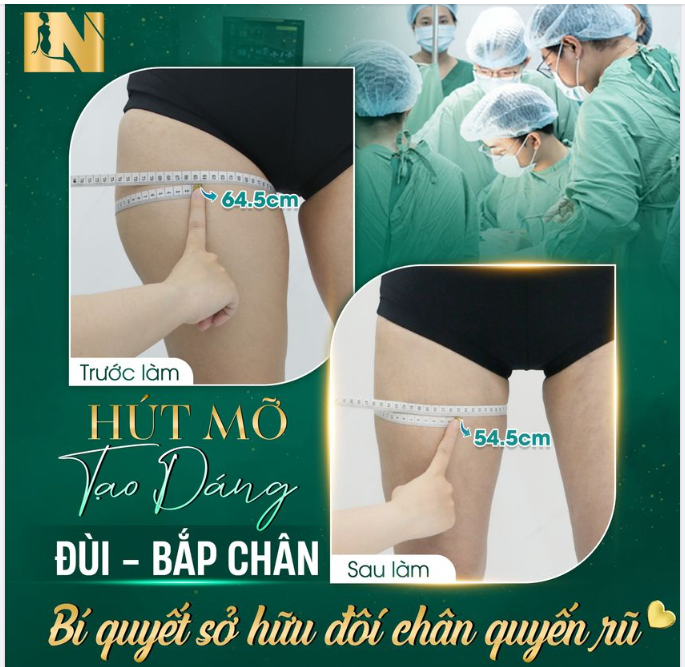 HÚT MỠ ĐÙI - BẮP CHÂN - BÍ QUYẾT SỞ HỮU ĐÔI CHÂN THON GỌN QUYẾN RŨ
