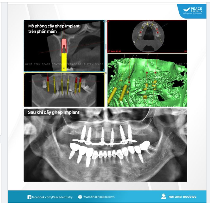 ĐẶT IMPLANT MÔ PHỎNG TRÊN PHẦN MỀM - SỰ ĐẢM BẢO CHO TÍNH CHÍNH XÁC VÀ TỐI ƯU TỪ VIỆC CHẨN ĐOÁN, LẬP KẾ HOẠCH ĐIỀU TRỊ CHO ĐẾN KẾT QUẢ THỰC TẾ