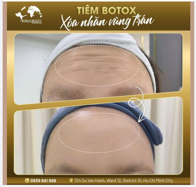 Tiêm Botox giúp hỗ trợ làm căng cơ, xóa nhăn trán hiệu quả mà không cần can thiệp ph.ẫu thuật.