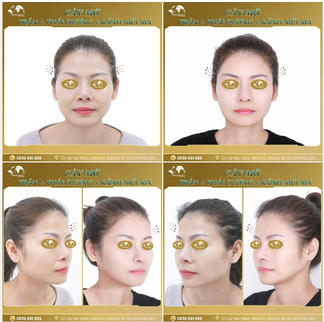 Trẻ hóa diện mạo bằng giải pháp cấy mỡ tự thân được xem là hiệu quả và an toàn vượt trội hiện nay.