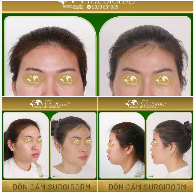 Những khiếm khuyết bẩm sinh của cằm: lẹm ngắn, mất cân đối, thiếu độ nhô tự nhiên khiến cho ngũ quan trên khuôn mặt không hài hòa.