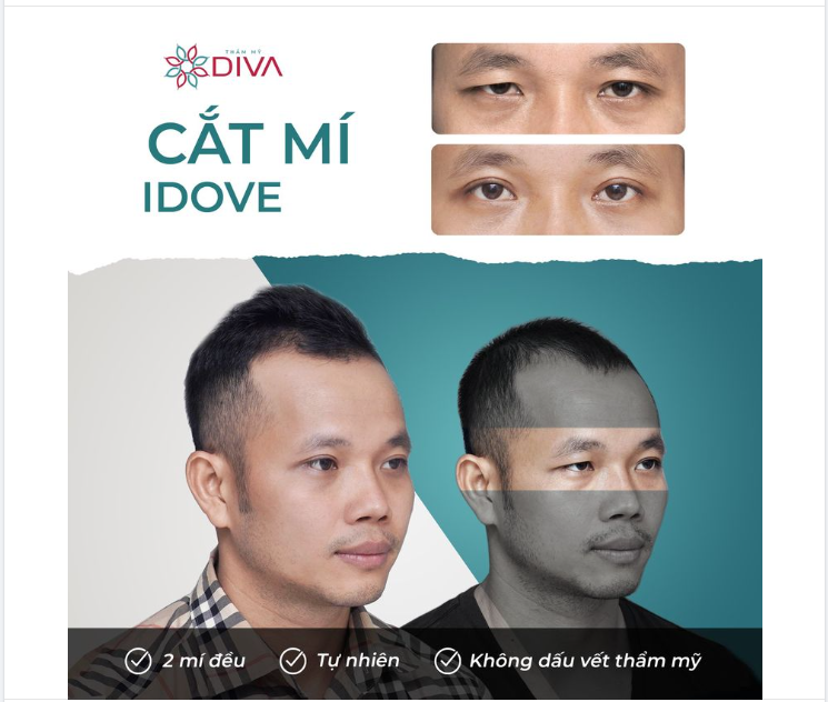 SỤP MÍ - MÍ MẮT KHÔNG ĐỀU PHƯƠNG PHÁP NÀO CẢI THIỆN?